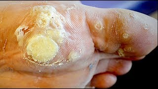 MASSIVE DEAD WART REMOVAL (this kid&#39;s a stud) | Dr. Paul