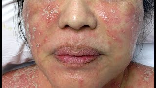 Managing Pustular Psoriasis on Your Face: A Comprehensive Guide