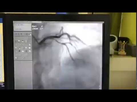 Rhythm Disorder Revealed In 68 Yr Old Patient