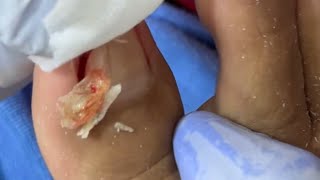 Ep_8922 Foot nails skin removal 👣 อันนี้..มันอยู่ข้างในหรือครับ 😅 (clip from Thailand)