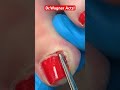 INGROWN TOENAIL REMOVAL MONEY SHOT Shorts