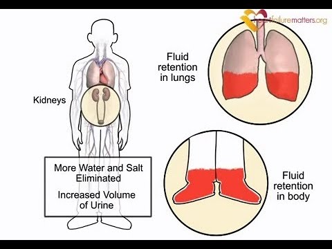 How diuretics work in heart failure