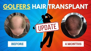 I Tried Hair Transplant for Golfers and Here's What Happened