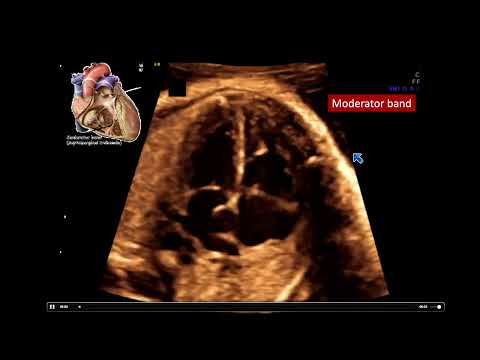2022 Fetal Echocardiography: Normal and Abnormal Hearts - A Video CME Teaching Activity