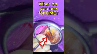 Saved from Endo….