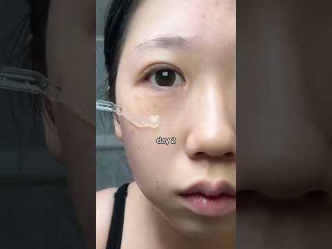 Freckles? Not a problem! 🚨👏🏻 ( Skin1004 Centella Tone Brightening Ampoule from 🩷Lamcy Korea 🩷)