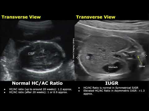 Obstetric Ultrasound Normal Vs Intrauterine Growth Restriction (IUGR) | Placental Insufficiency USG