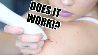 TESTING VIRAL AT HOME MOLE, TATTOO, SKIN TAG REMOVAL PEN! Does It Really Work!?