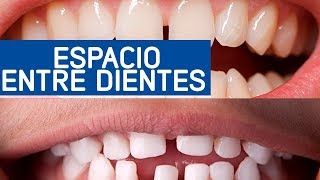 Estética dental, espacio entre dientes (problema/solución) / Odontoespecialistas