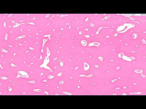 Osteoma of Bone: Bone forming tumors, Part 1