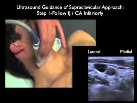 How to: Supraclavicular Approach to Subclavian Vein Cannulation