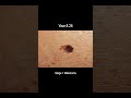 Melanoma Skin Cancer Development Time Lapse (Normal to Stage 4 Melanoma Over 10 Years)