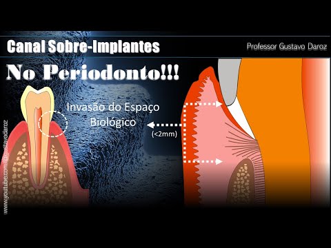 O que é o ESPAÇO BIOLÓGICO do dente? #odontologia  #protesesobreimplante #periodontia
