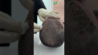 Removing scabs after hair transplant  #hairtransplantturkey #пересадкаволосвтурции