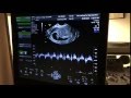 8 Weeks Pregnant Ultrasound Baby Heartbeat