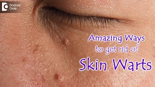 AMAZING WAYS TO GET RID OF SKIN WARTS | Skin Wart Removal Tips - Dr.Nischal K | Doctors