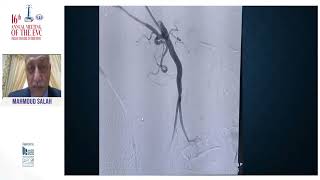 Download Lagu Vascular online training Prof mamoud salah management of visceral aneurysms Thumbnail