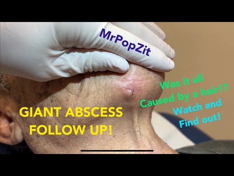 Giant chin abscess follow up! Was it all caused by a HAIR!? See the interesting dissection here!