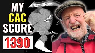 My Shocking CAC Score: What I’m Doing to Reduce My Heart Attack Risk!