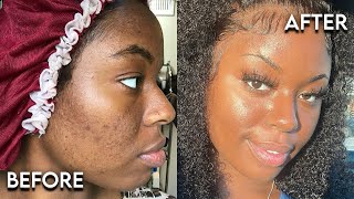 HOW TO: GET RID OF STUBBORN ACNE OVERNIGHT 😱😱... WITHOUT WASHING YOUR FACE!!! NO PRODUCTS NEEDED