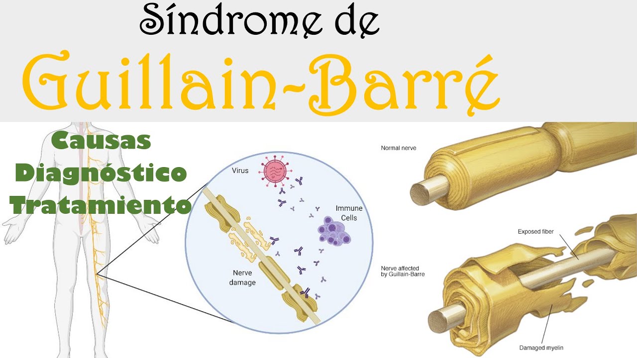GUILLAIN-BARRÉ: QUÉ ES, CAUSAS, SÍNTOMAS, FISIOPATOLOGÍA, DIAGNÓSTICO Y TRATAMIENTO.