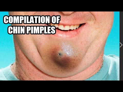 Chin Zits!  Chin Blackheads, Chin Pimples and Pimple Pops!