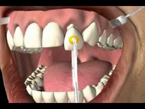 wie entfernt der Zahnarzt eine alte Zahnkrone aus dem Mund