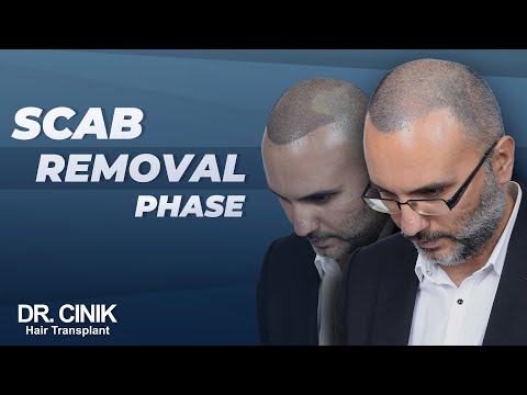 Scab Removal Phase | Dr.Cinik Hair Transplant