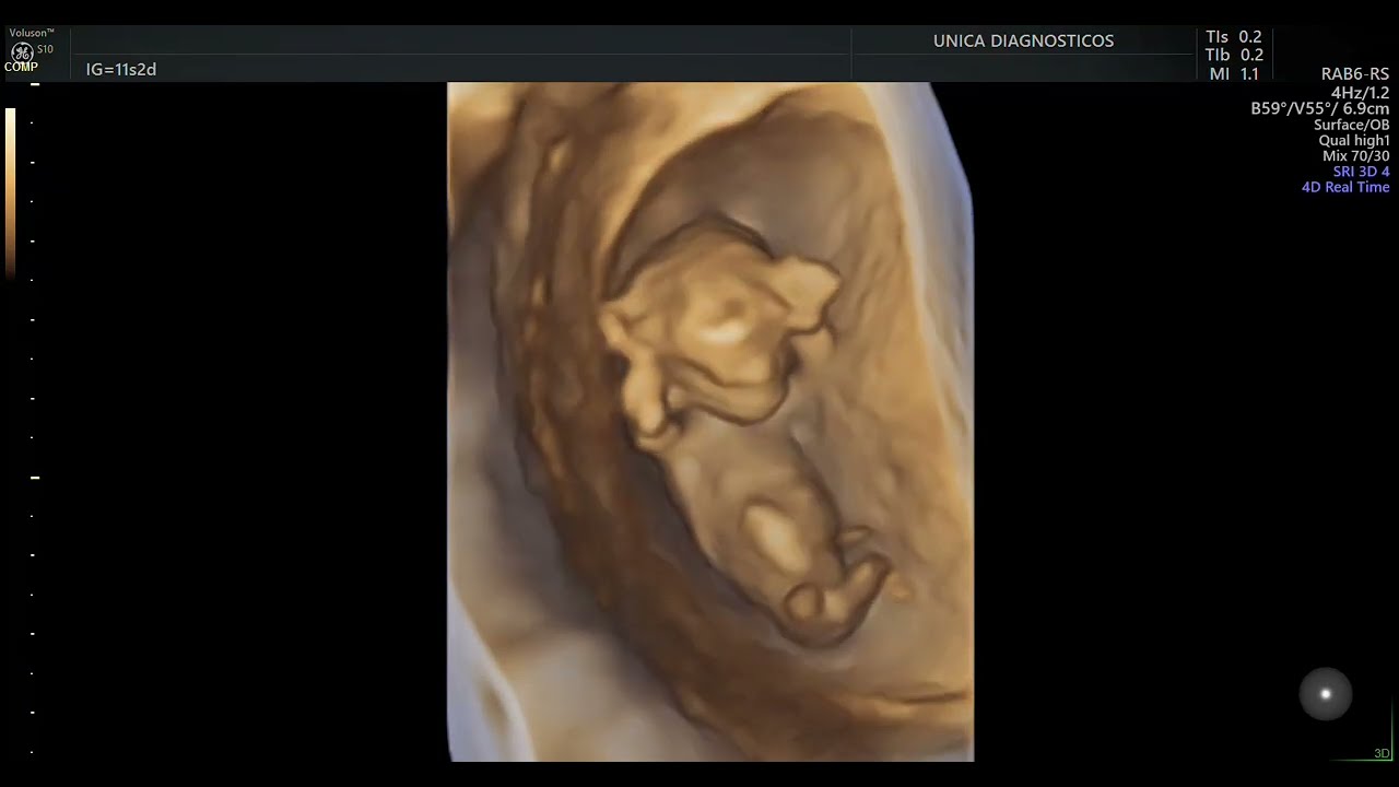 Ultrassom 4D em gestação de 12 semanas - 2