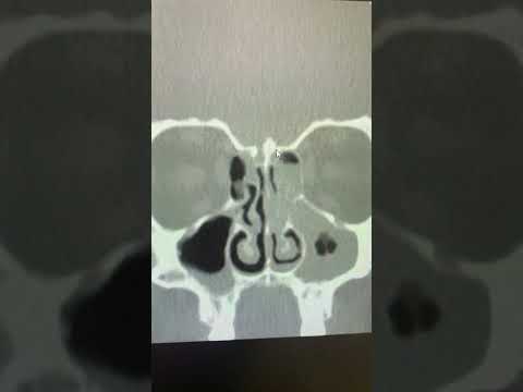 Tomografia computadorizada Seio/PNS Como ler Doença sinusal unilateral Seio paranasal
