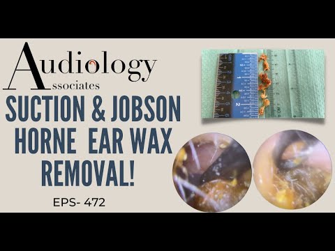 SUCTION & JOBSON HORNE EAR WAX REMOVAL - EP472