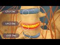 Herniated Disc 3d medical animation