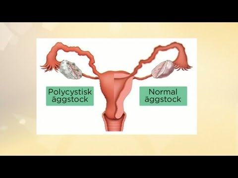Hur vet jag om jag har PCOS? - Nyhetsmorgon (TV4)