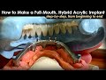 How to Make a Full-Mouth Hybrid Acrylic Implant : Step-By-Step from Beginning to End
