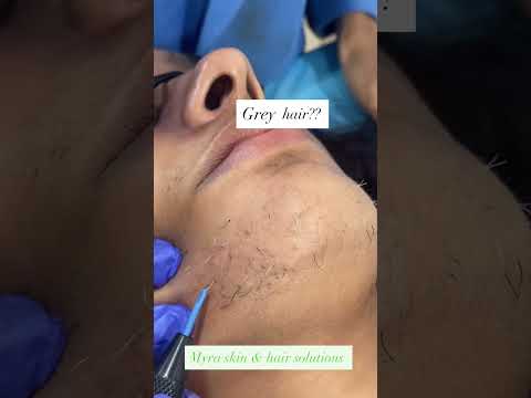 Permanent facial hair removal with electrolysis #hairremoval #electrolysis #whitehairtreatment #hair
