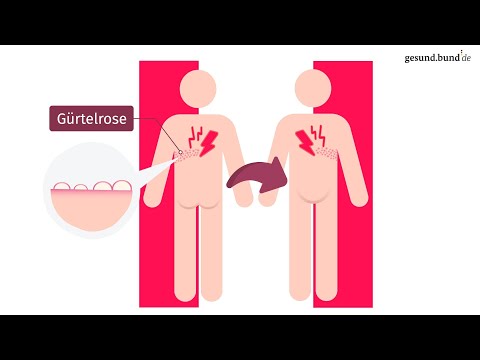 How does shingles develop?