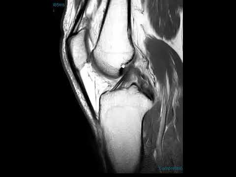 Posterior Cruciate Ligament (PCL) tear