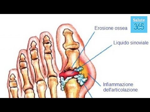 Cosa fare con il dolore alle articolazioni delle gambe rimedi popolari Metodo Bubnovskaya con osteoartrosi dellarticolazione dellanca