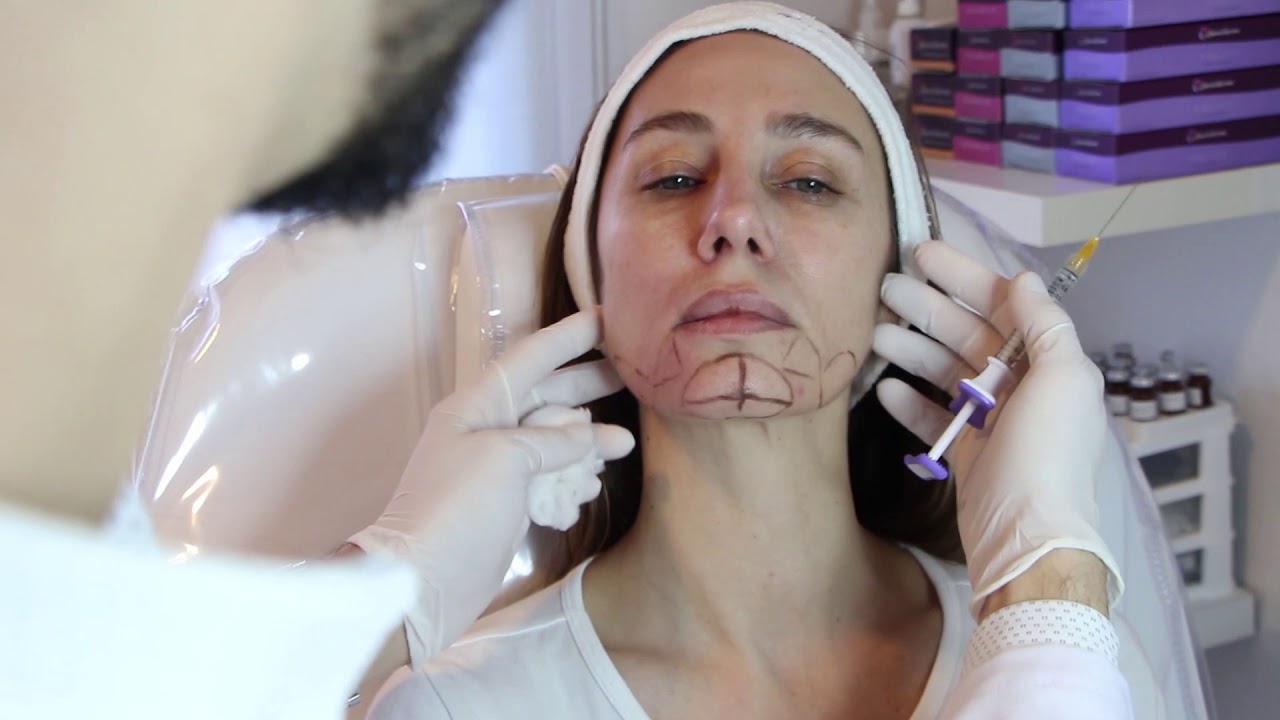 Watch Relleno Facial Tercio Inferior - La Silueta Now Relleno Facial Tercio Inferior - La Silueta