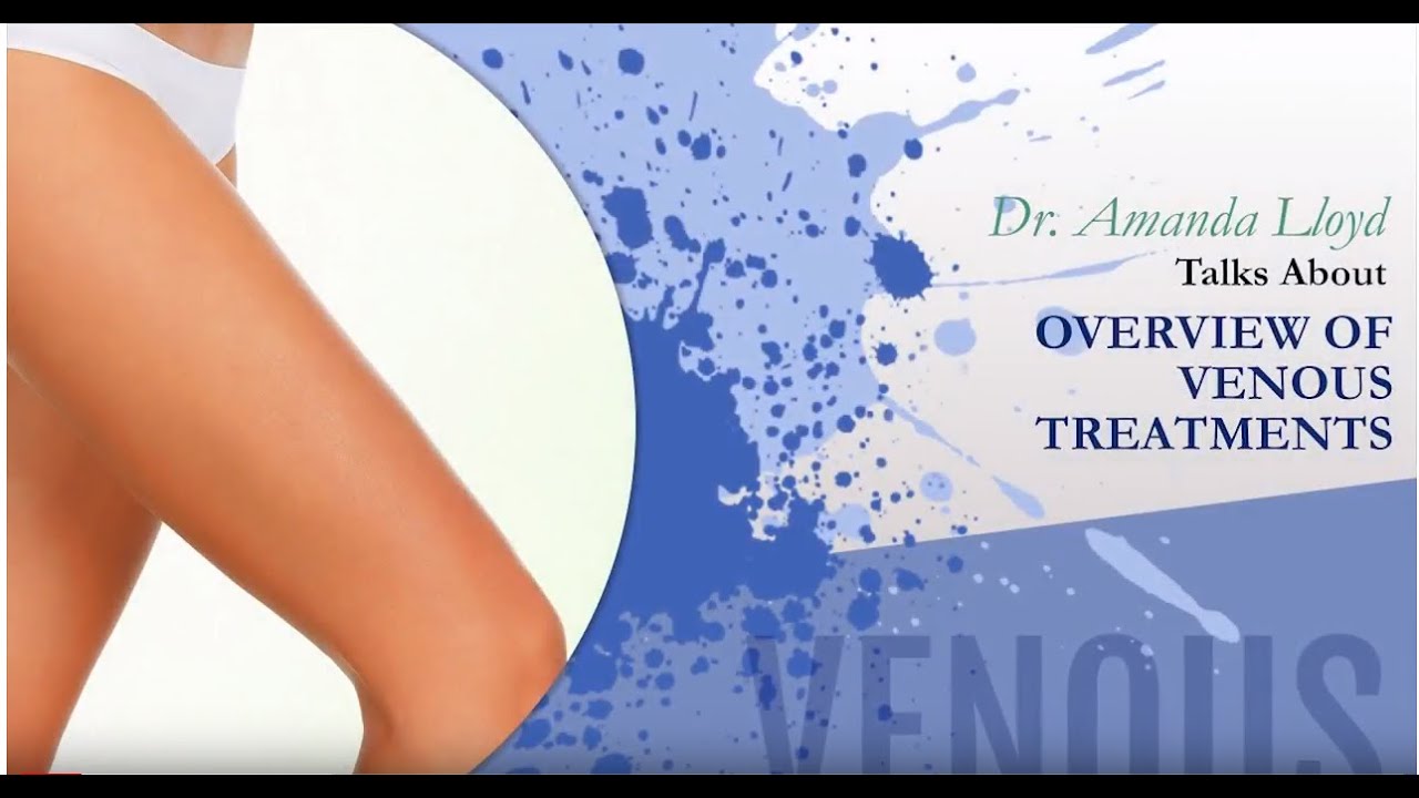 Overview of Venous Treatments - Encinitas CA