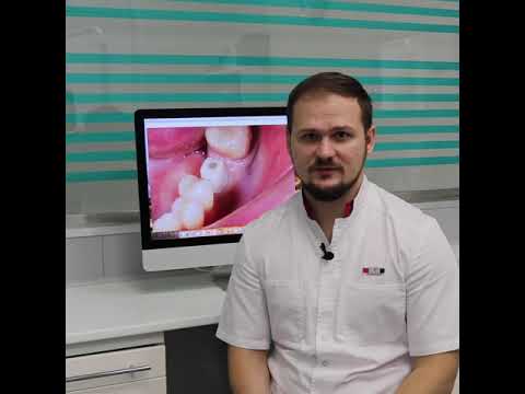 Ответы на вопросы по имплантации