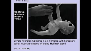 Werdnig Hoffmann disease SMA type 1; genetic neuromuscular disorder that presents in infancy