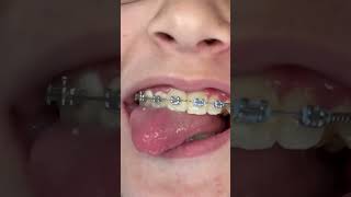 Light Blue Braces Colors 💙