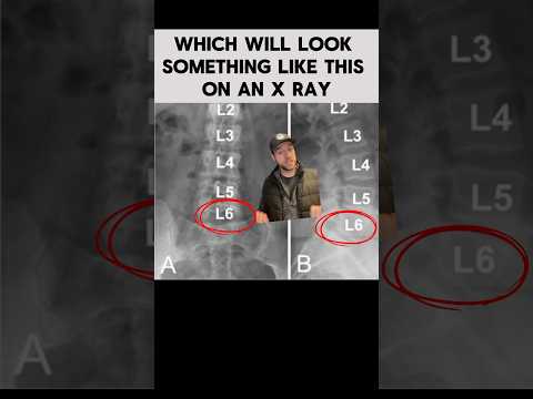 Is it Normal to Have a 6th Lumbar Vertebrae? #lumbarspine #vertebrae #xray #MRI #spine