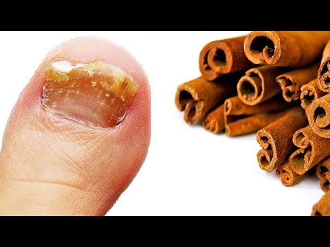 Kein Pilz überlebt dieses starke Rezept mit Zimt!