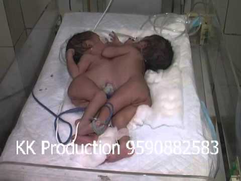 Rare conjoined twins born in Agra