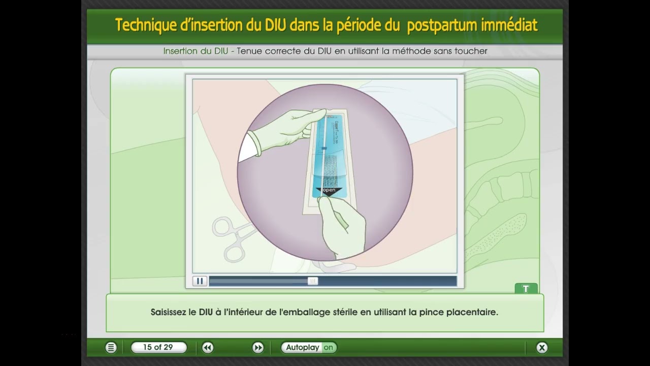 Technique d'insertion du DIU