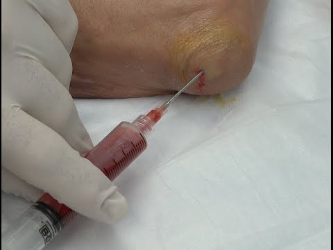 Wie wird man von Spannung und Steifheit in den zervikalen thorakalen befreien Aufgrund dessen halten die Gelenke