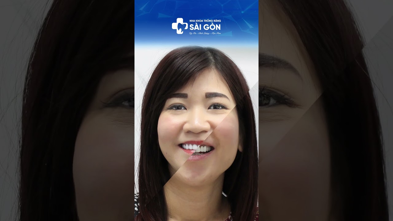 Case Bọc 19 Răng Toàn Sứ Lava Plus | Nha Khoa Trồng Răng Sài Gòn #bocrangsu #rangsuthammy