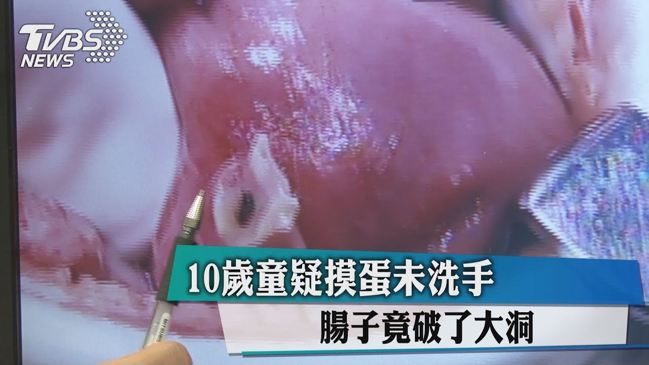 10歲童疑摸蛋未洗手 腸子竟破了大洞!